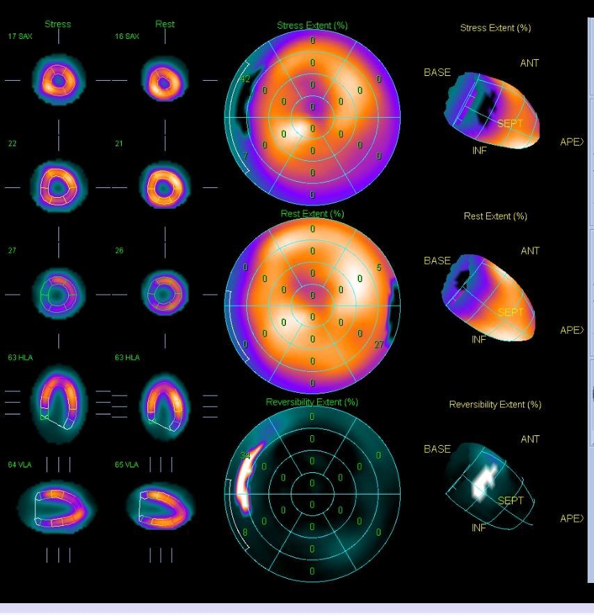 Myocardial Perfusion Heart Scan Perth | Envision Medical Imaging