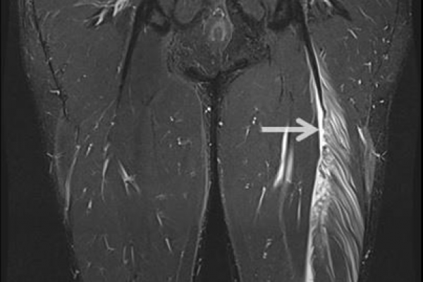 Ultrasound Guided Percutaneous Neurolysis for Sciatic Nerve Tethering Post Mid-Hamstring Tendon Repair