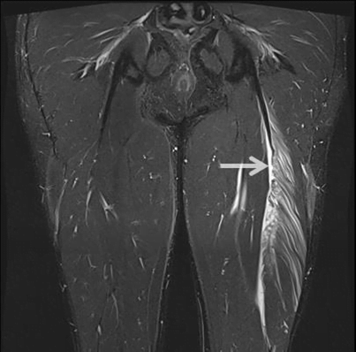 Ultrasound Guided Percutaneous Neurolysis for Sciatic Nerve Tethering Post Mid-Hamstring Tendon Repair