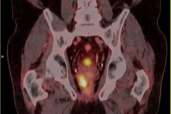 pet psma scan