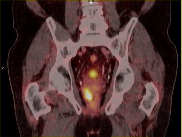 pet psma scan