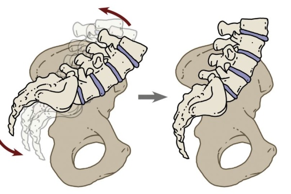 Sciatica Pain Diagram